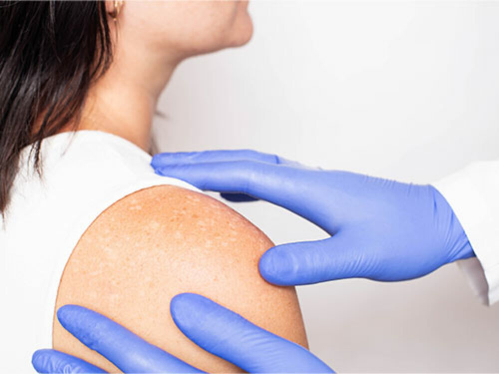 Pigmentflecken - Dermatologie am See