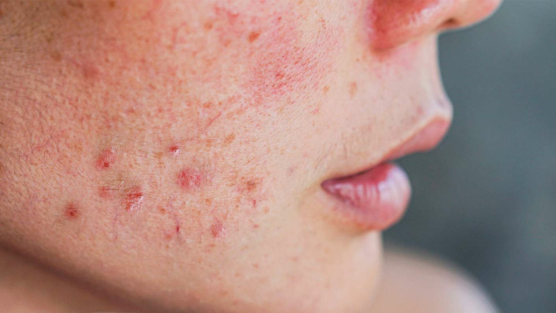 Rosacea behandeln bei Ihrem Hautarzt