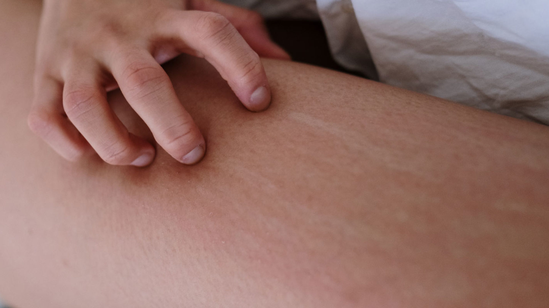 Juckende Haut bei einer Allergie