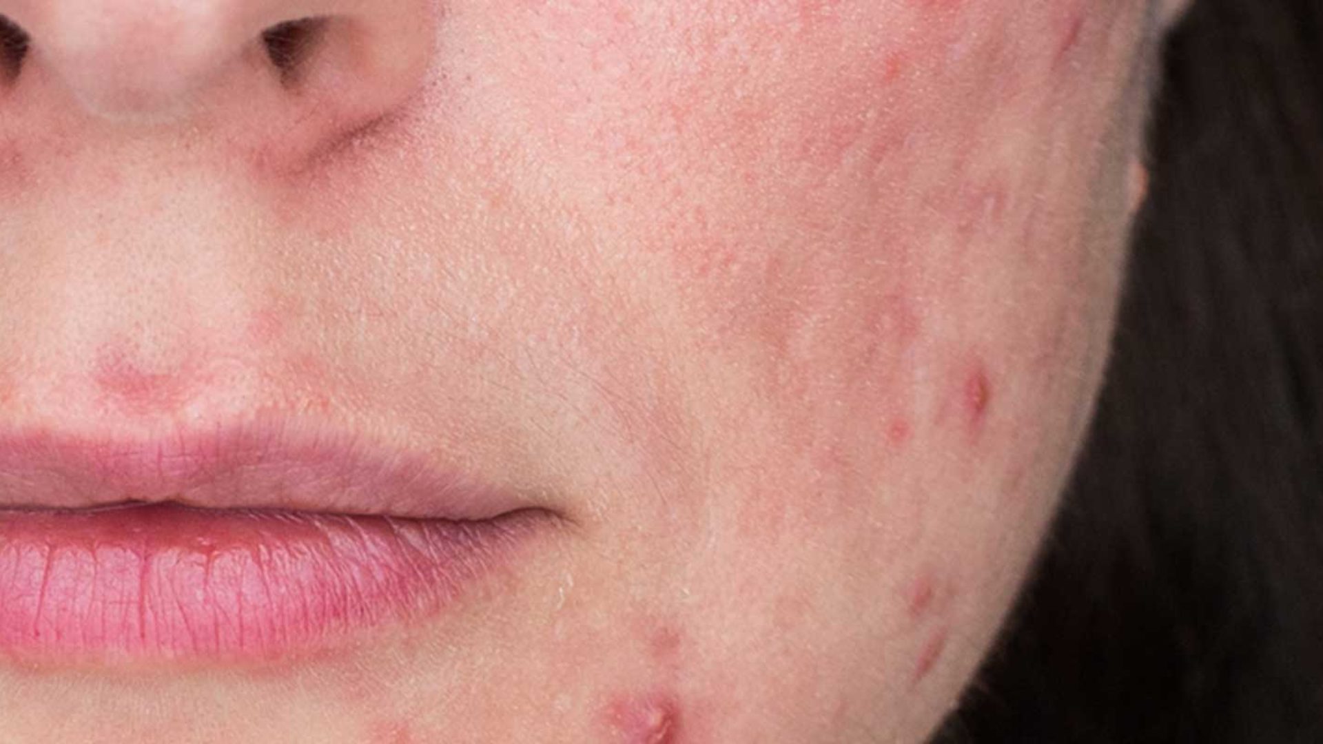 Haut mit Rosacea