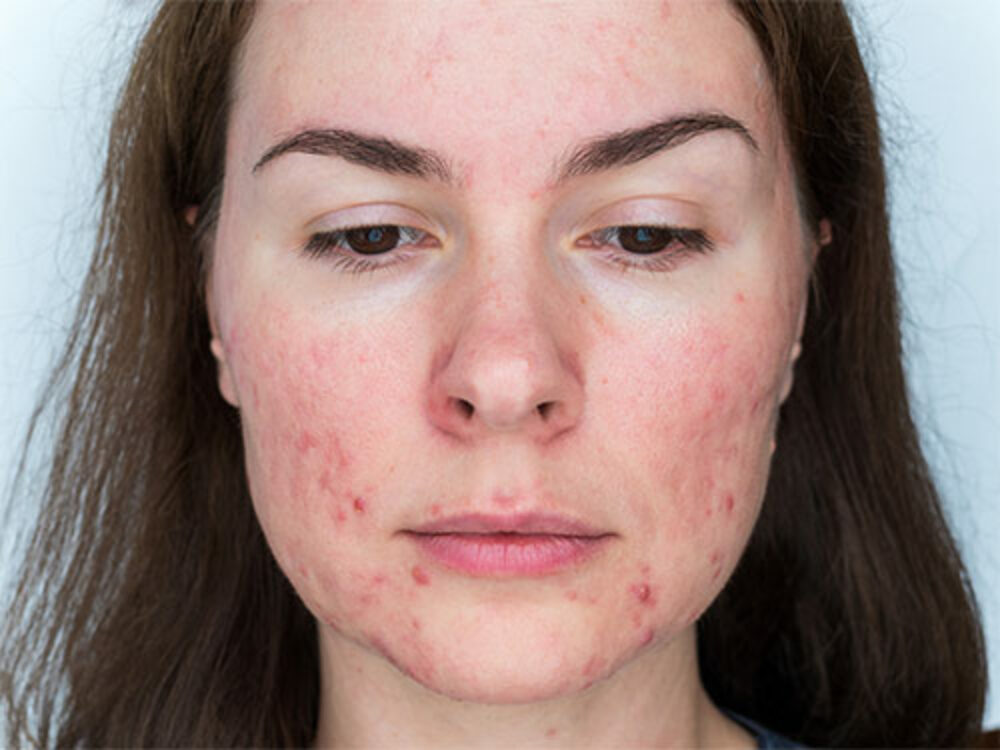 Rosacea bei Ihrem Hautarzt in Feldmeilen behandeln lassen