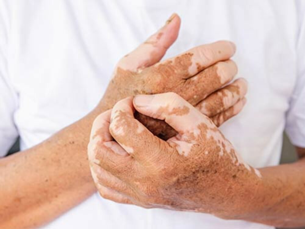 Vitiligo beim Hautarzt behandeln lassen
