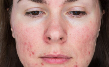 Was ist Rosacea?